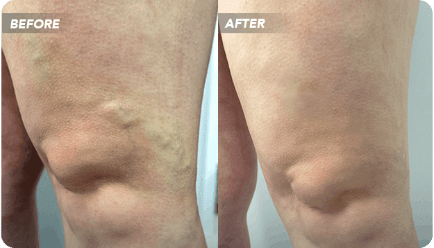 Sclerotherapy Before and After