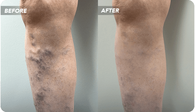 VTC-Before-After-4 Sclerotherapy Before and After