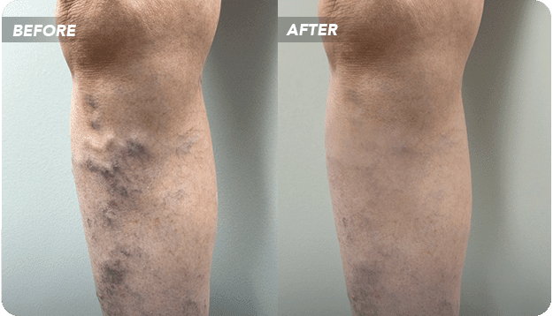 Sclerotherapy Before and After