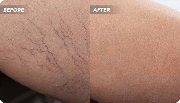 VTCBefore-After-12_1 Sclerotherapy Before and After