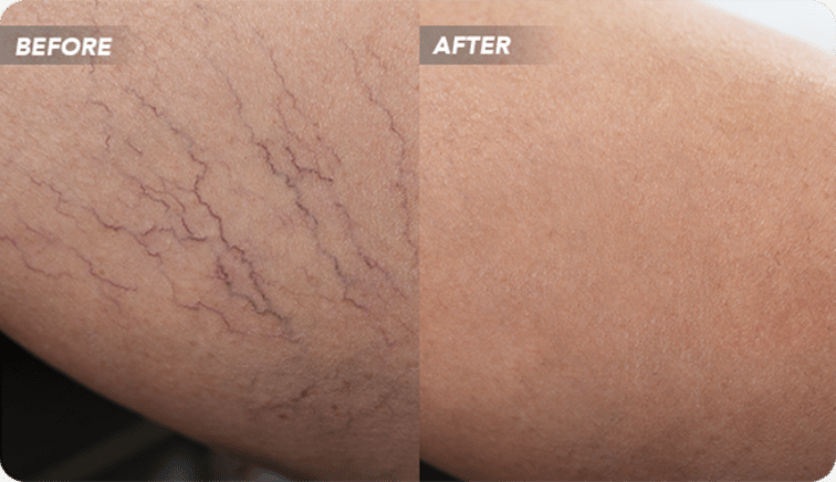 Sclerotherapy Before and After