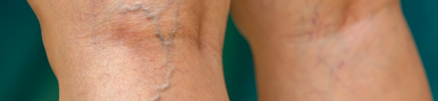 Spider Veins green bkgd