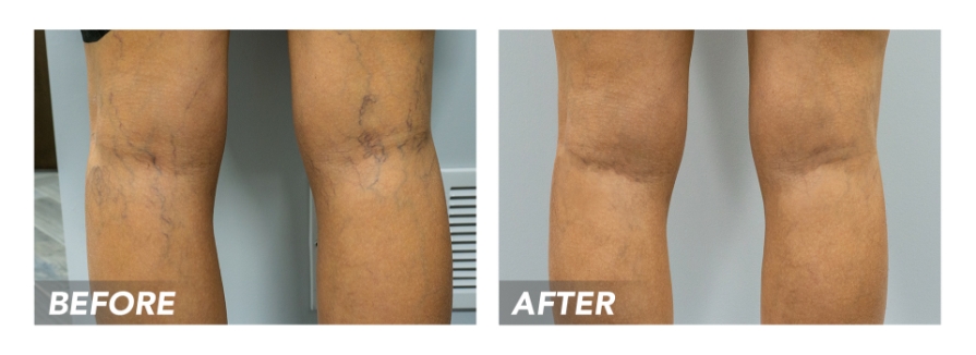 Before-After-SpiderVeins-Patient1