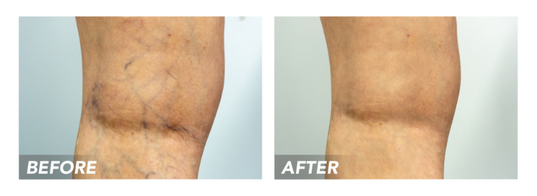 Before-After-SpiderVeins-Patient2 Before-After-SpiderVeins-Patient2