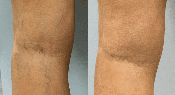 The Best Varicose Vein Center in New York, 2021