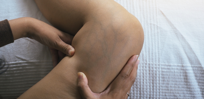 Your 5-step Plan to Beautiful Legs: Get Personalized Spider Vein Treatment in New Jersey