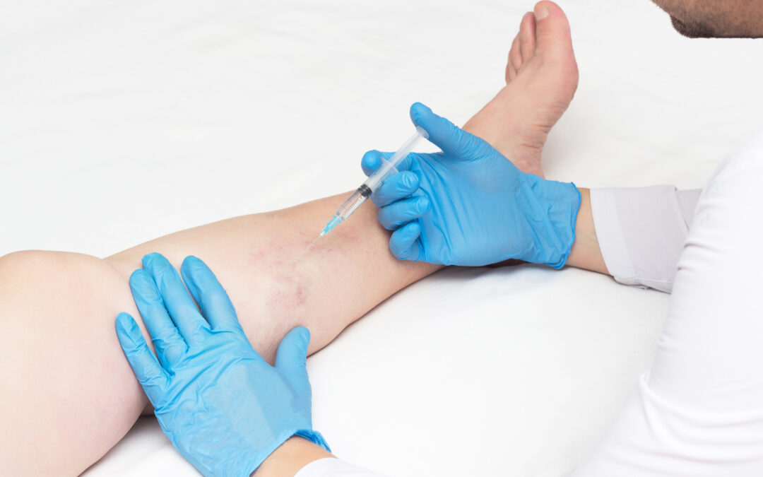 What is the Best Spider Vein Clinic in Manhattan?