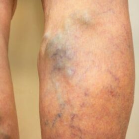 Can you have varicose veins removed? Should I get my varicose veins treated? You can definitely undergo varicose vein treatments — this article shows you how.