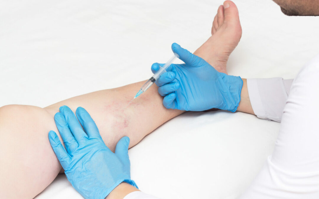 What Is The Latest Technology for Varicose Veins?