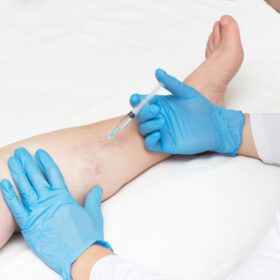 Can You Have Varicose Veins Removed? Yes, You Can!