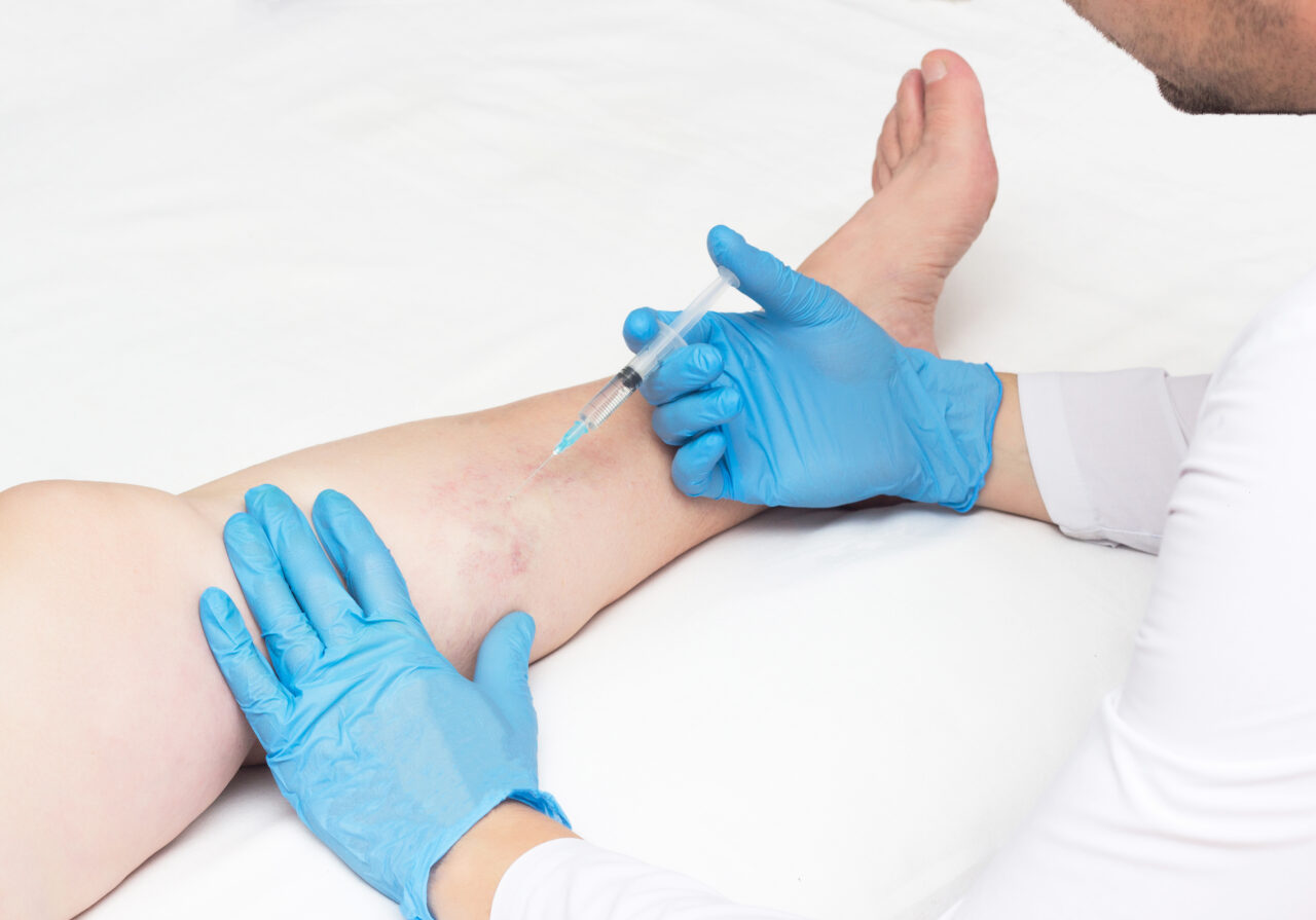 Do you have questions about the spider vein and varicose vein treatment process? The leading spider vein dr. in Midtown describes minimally invasive vein treatments.