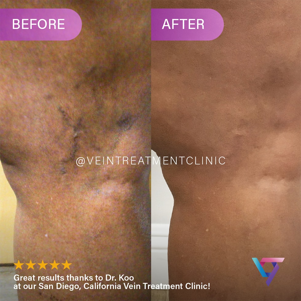 B&A 1 If you have decided to get your varicose veins removed, you probably want to know all about the treatment process. This article discusses what you need to do before and after varicose vein removal.