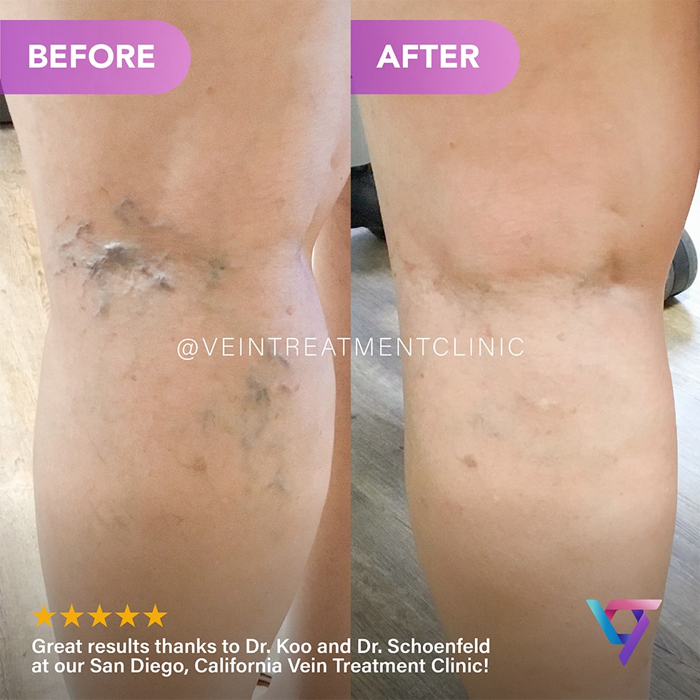 B&A 10 VTC Before-After-10