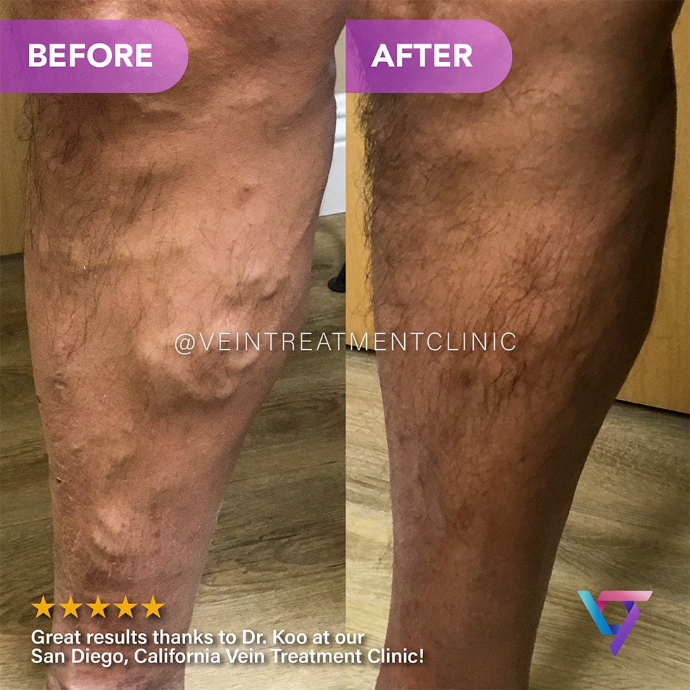 B&A 11 VTC Before-After-11