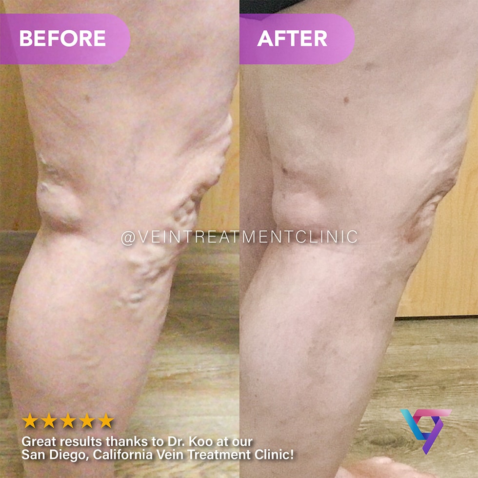 B&A 12 VTC Before-After-12