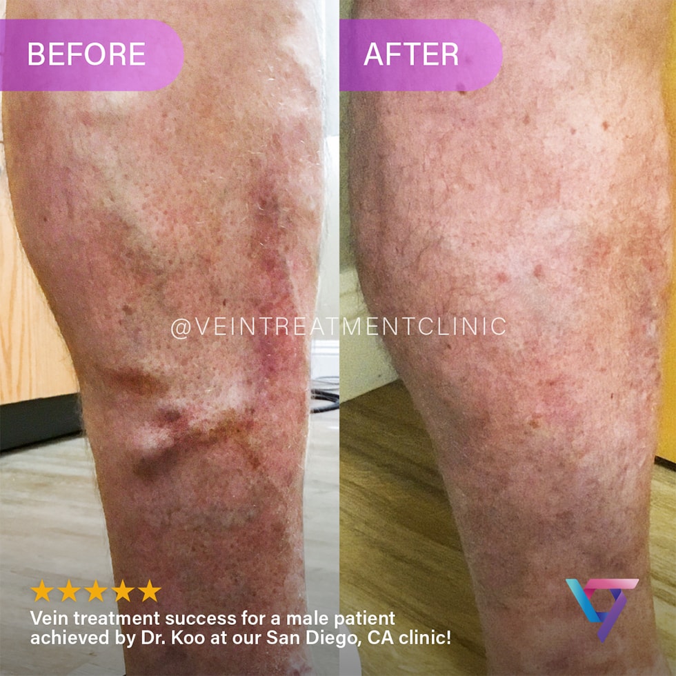 B&A 2 VTC Before-After-1