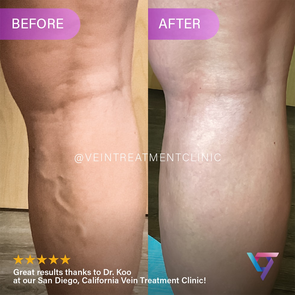 B&A 3 VTC Before-After-0