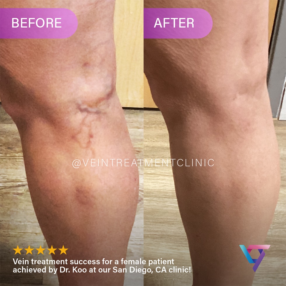B&A 4 VTC Before-After-3