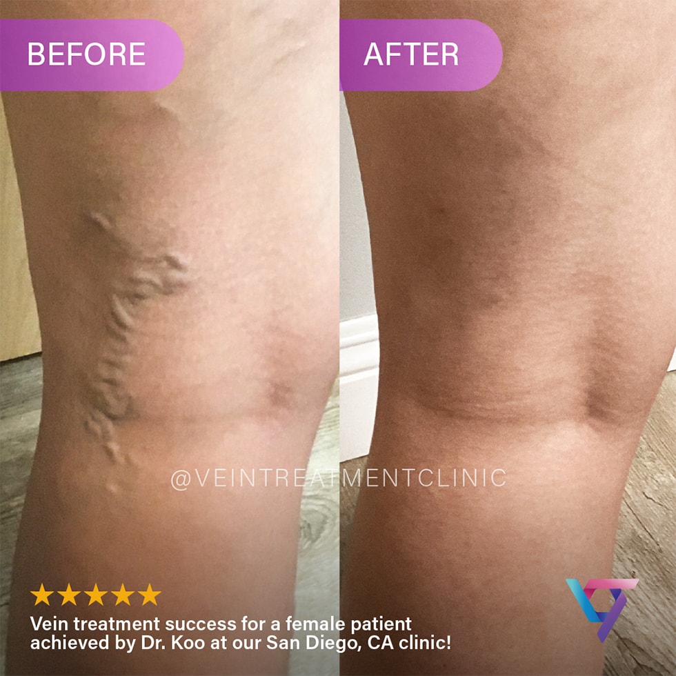 B&A 5 VTC Before-After-4