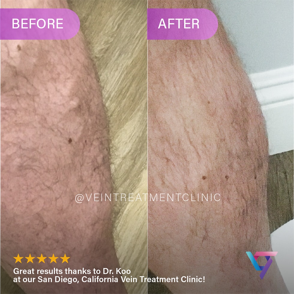 B&A 7 Have you been considering laser treatment for spider veins? This article will tell you why laser vein removal centers may not be the ideal option – and what you should look for instead.