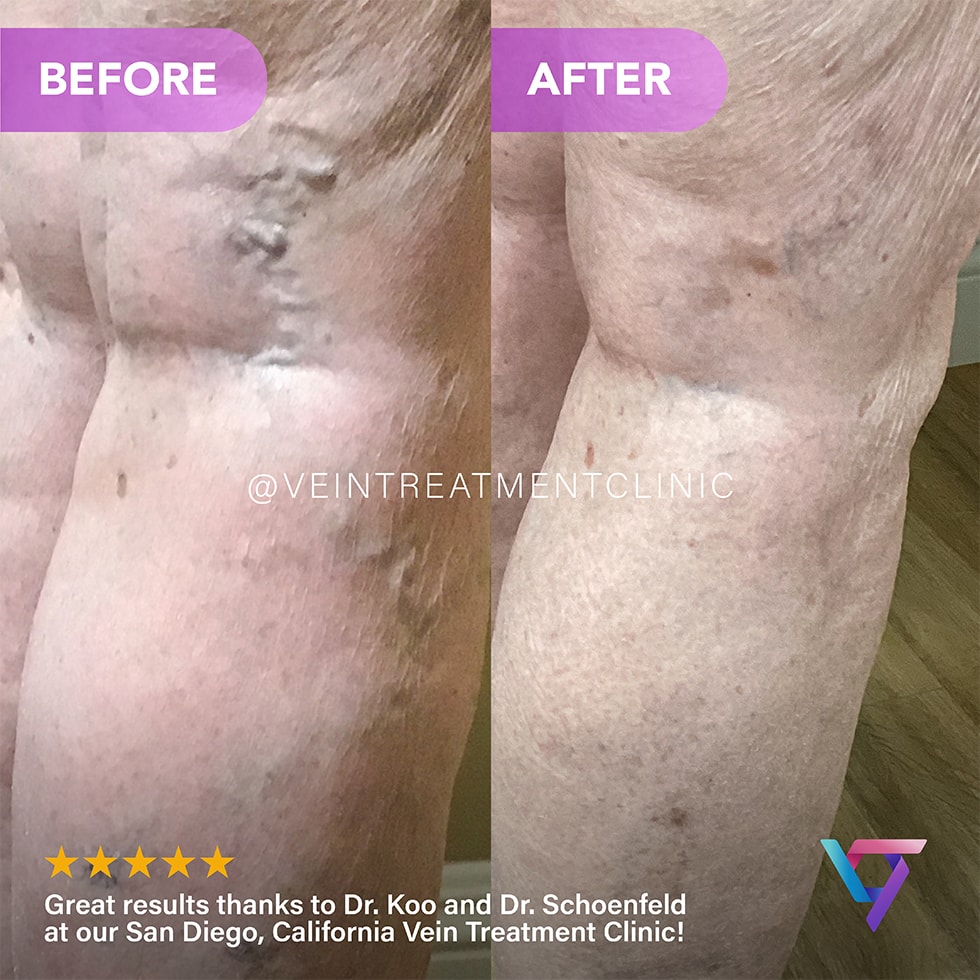 B&A 9 VTC Before-After-8