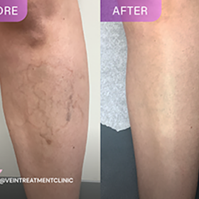 What is the best treatment for varicose veins? Discover the best treatments for varicose veins. From minimally invasive procedures to lifestyle tips, find relief with Vein Treatment Clinic.
