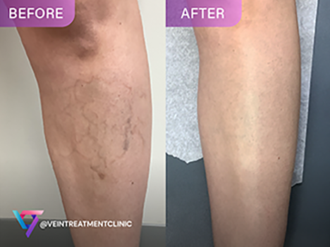 Spider Veins Before and After comparison for social media