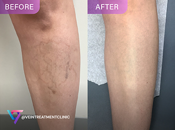 Dr. Arnold Spider Veins Before After Photo
