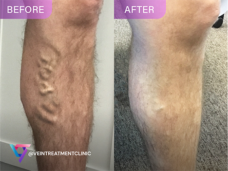 Varicose Veins Before and After comparison for social media