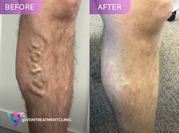 Dr. Arnold Varicose Veins Before After Photo