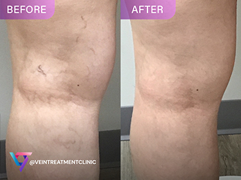 Dr. Shair Spider Veins Before After Photo