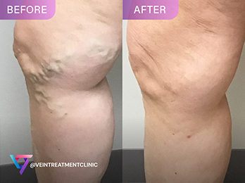 Dr. Shair Varicose Veins Before After Photo