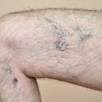 Spider-Veins-Vein-Treatmetn-Clinic