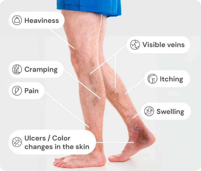 Symptoms-for-Venous-Insufficiency Symptoms-for-Venous-Insufficiency