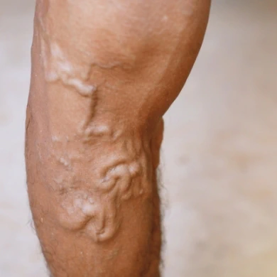 How long does varicose vein treatment take? We describe how long varicose vein treatments take, ranging from sclerotherapy to ambulatory phlebectomy.
