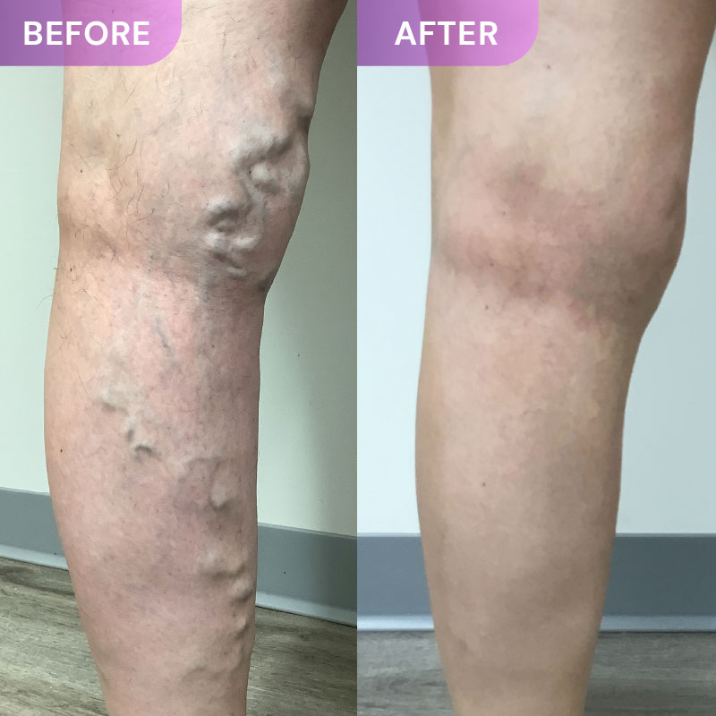 leg before and after our treatments