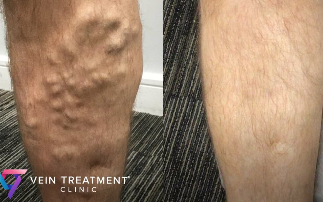 Can Sclerotherapy Fix Spider Veins and Varicose Veins?