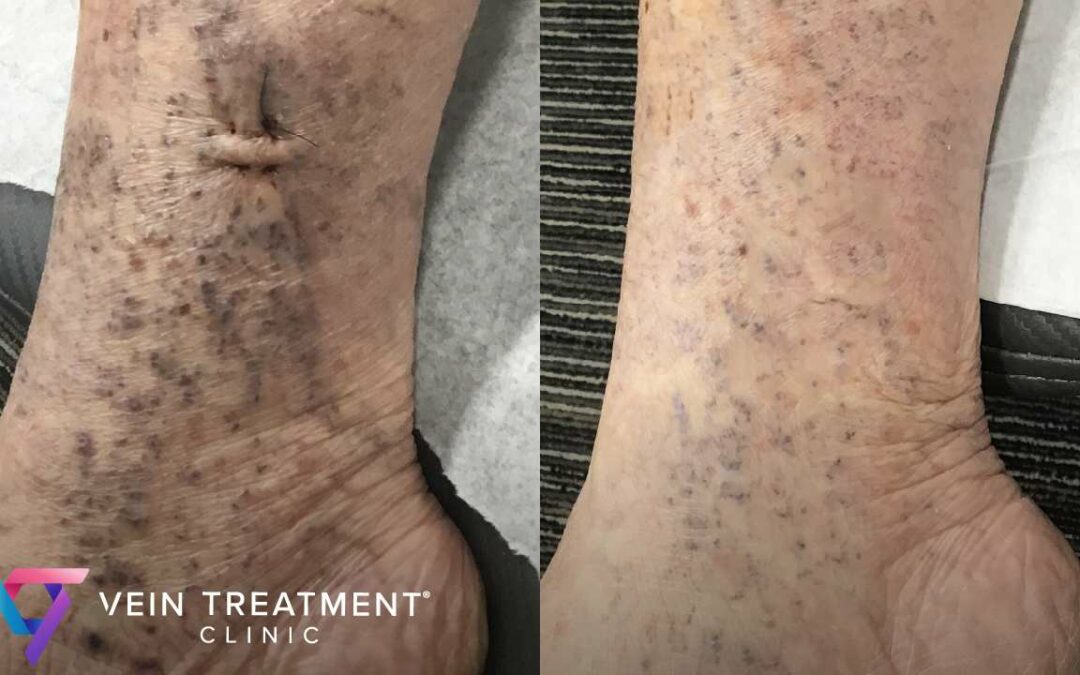 What are the Main Causes of Venous Insufficiency?