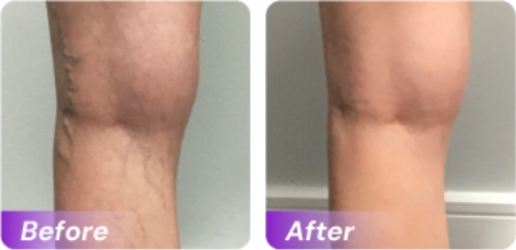 Vein Free Legs Spider Vein Treatment Before and After
