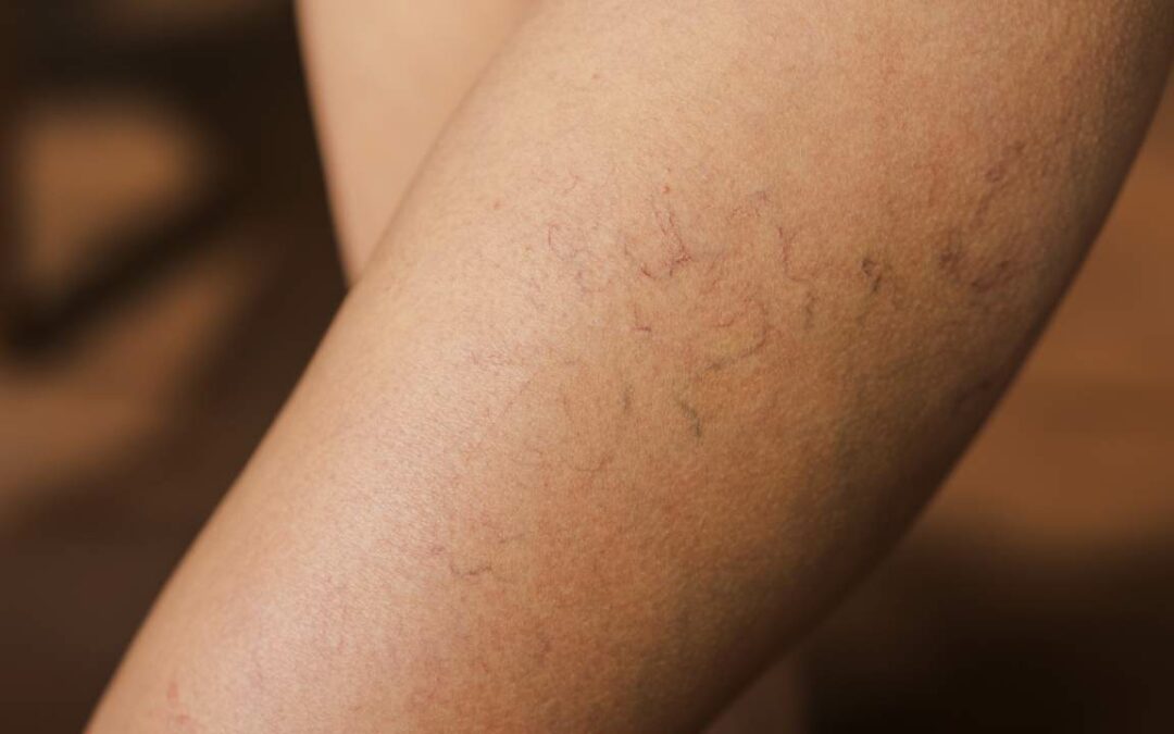 What Causes Spider Veins? Treatments and Preventions