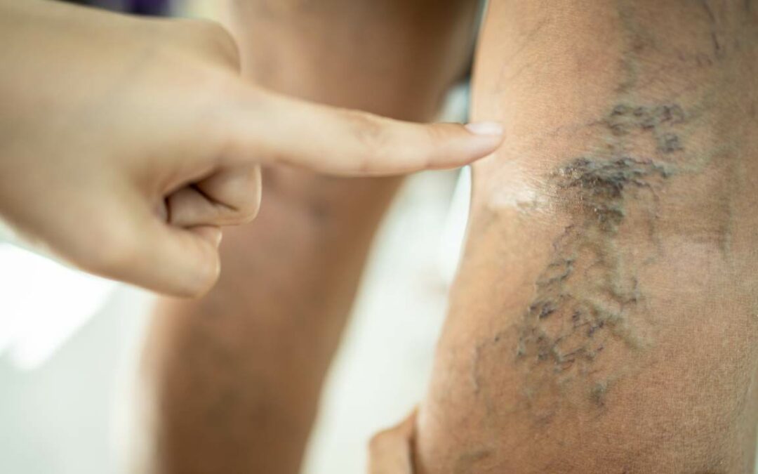 When to Worry About Varicose Veins? Don’t Wait Too Long!