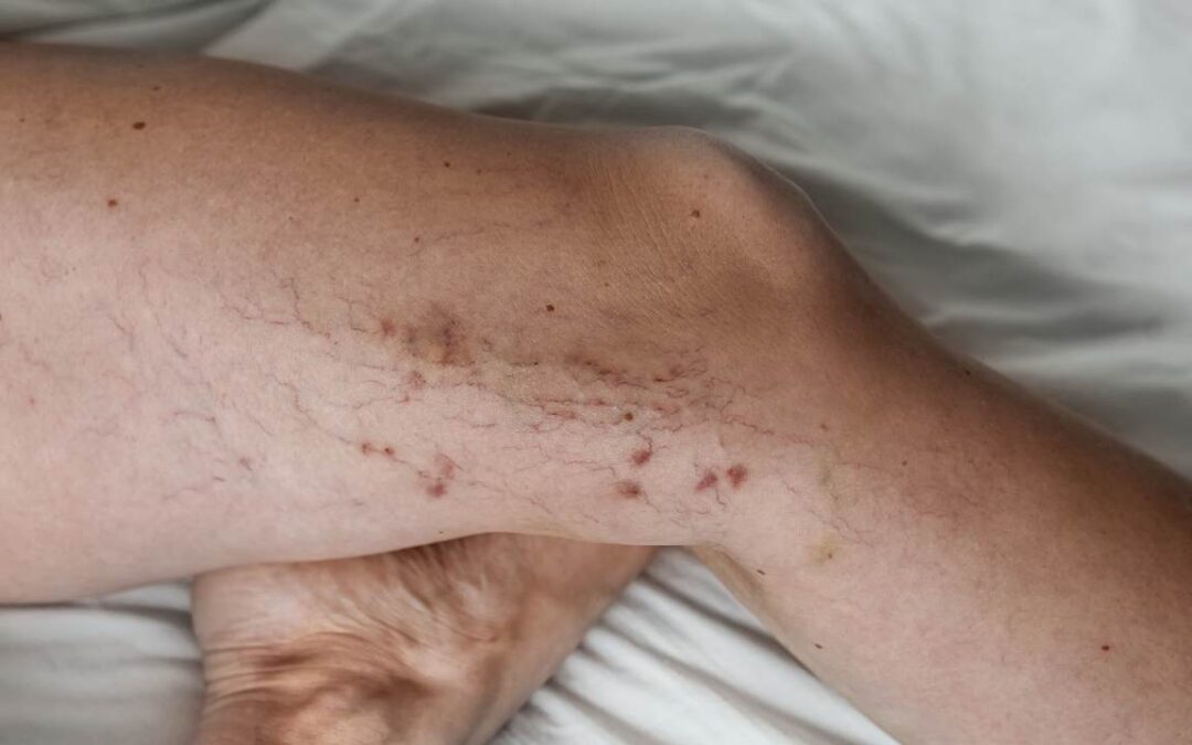How to Get Rid of Spider Veins? 5 Effective Treatments