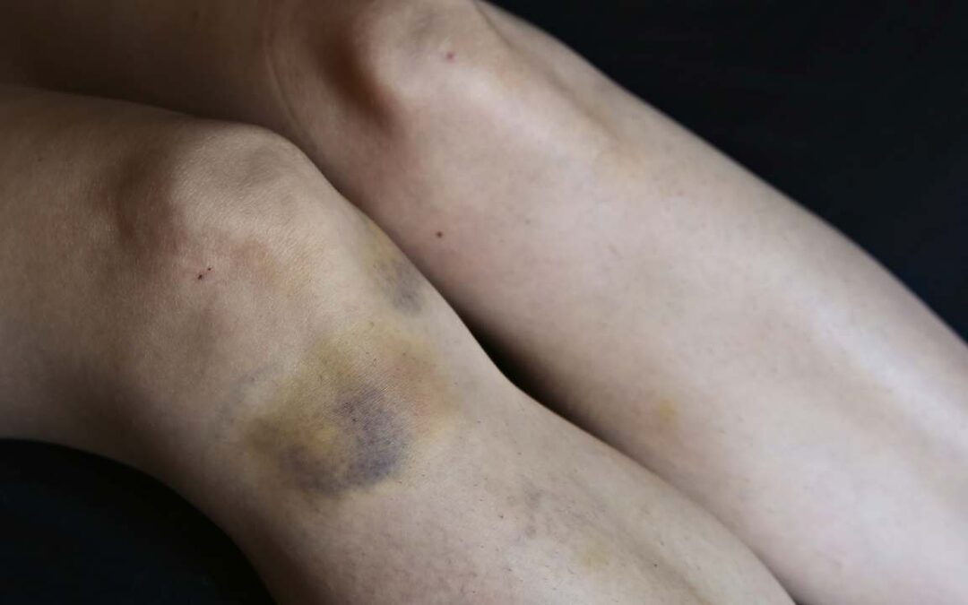 Is Bruising Related to Varicose Veins?