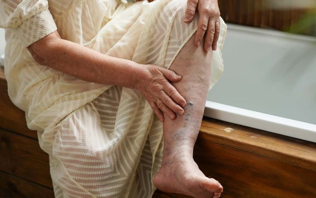Are Green Veins a Sign of Varicose Veins? Find out today!