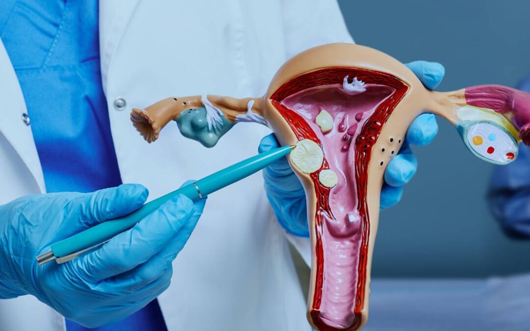 Uterine Fibroid Embolization: Non-Surgical Fibroid Treatment