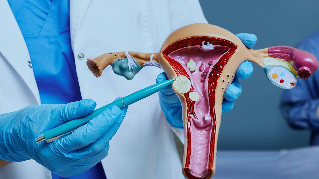 Uterine Fibroid Embolization: Non-Surgical Fibroid Treatment
