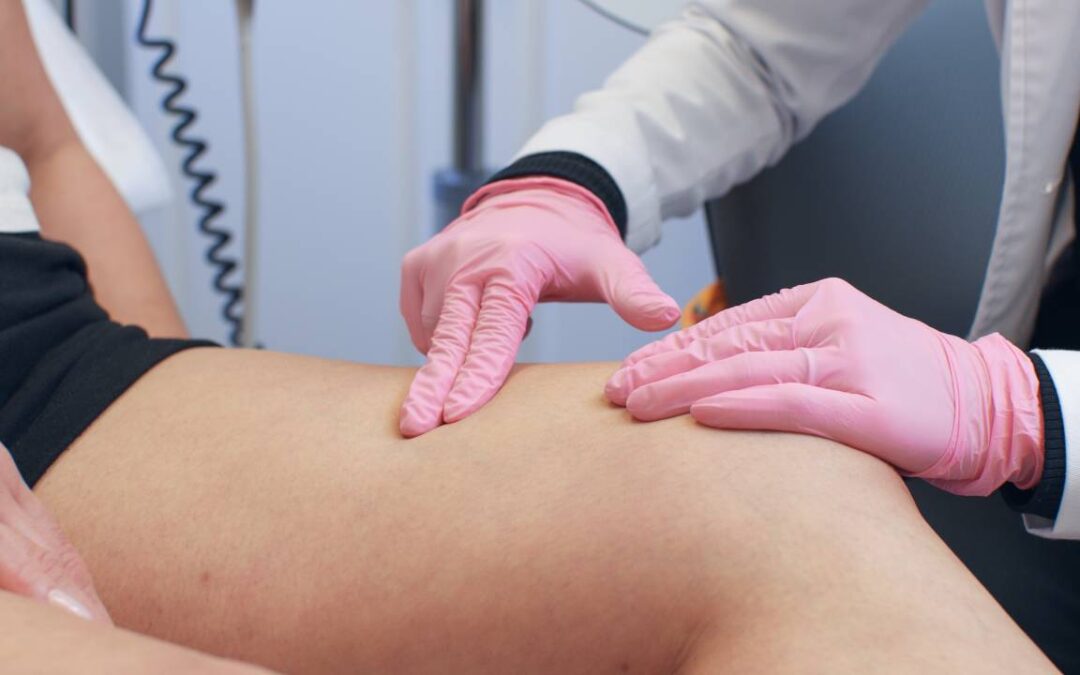 5 Expert Recommendations on How to Prevent Spider Veins