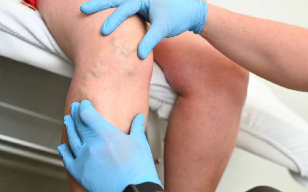 What Is Vein Stripping? Minimally Invasive Alternatives
