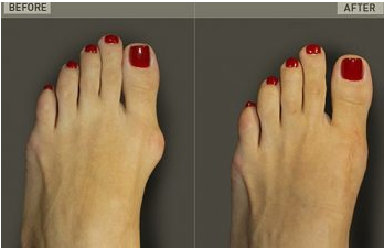 When Foot Pain Becomes a Cosmetic Concern