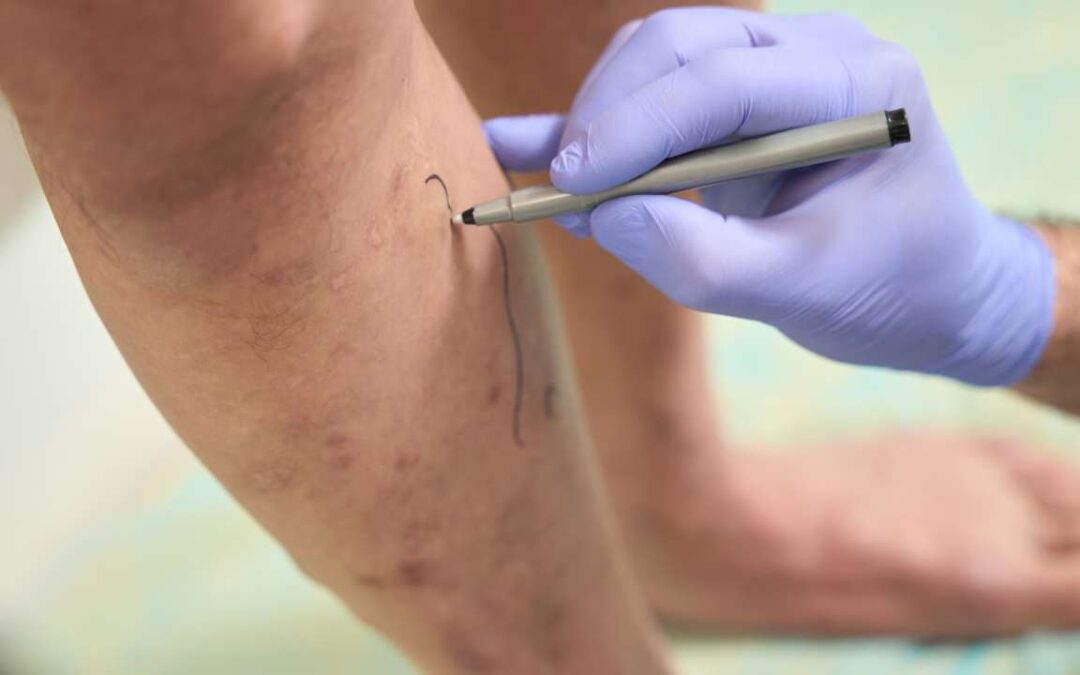 Vein Surgery is Not the Solution! Find New Alternatives